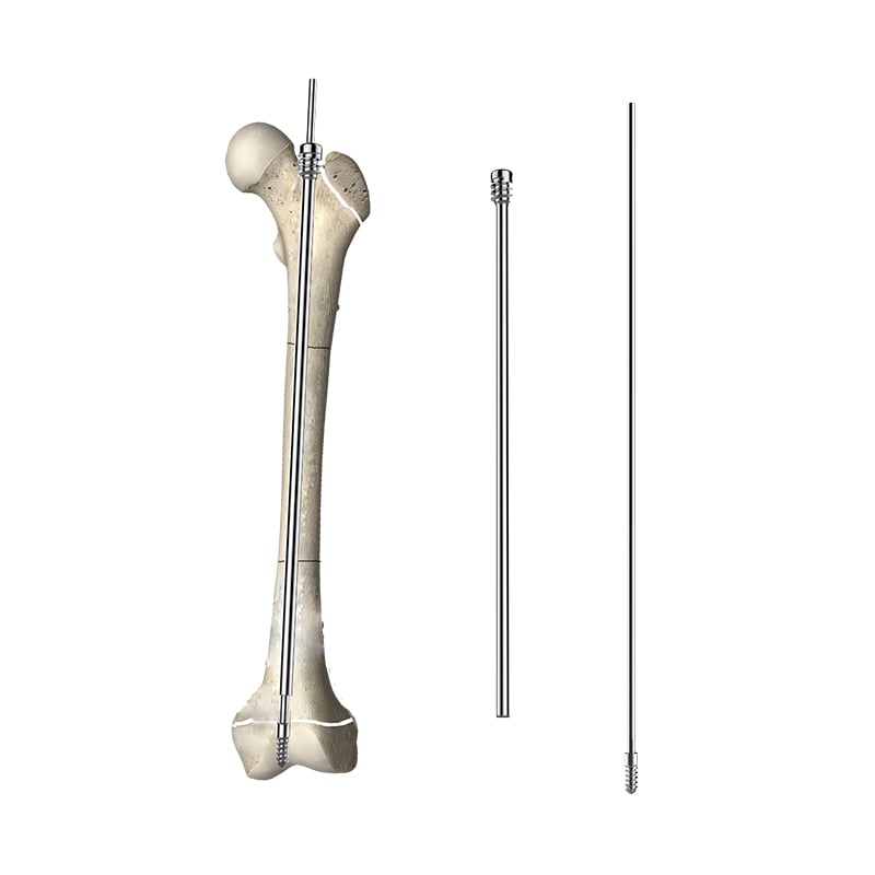 Telescopic Intramedullary Nail I